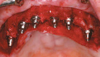 All on 6 dental implant abutments costa rica