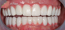 All on 6 Costa Rica Dental Implants Save A Lot