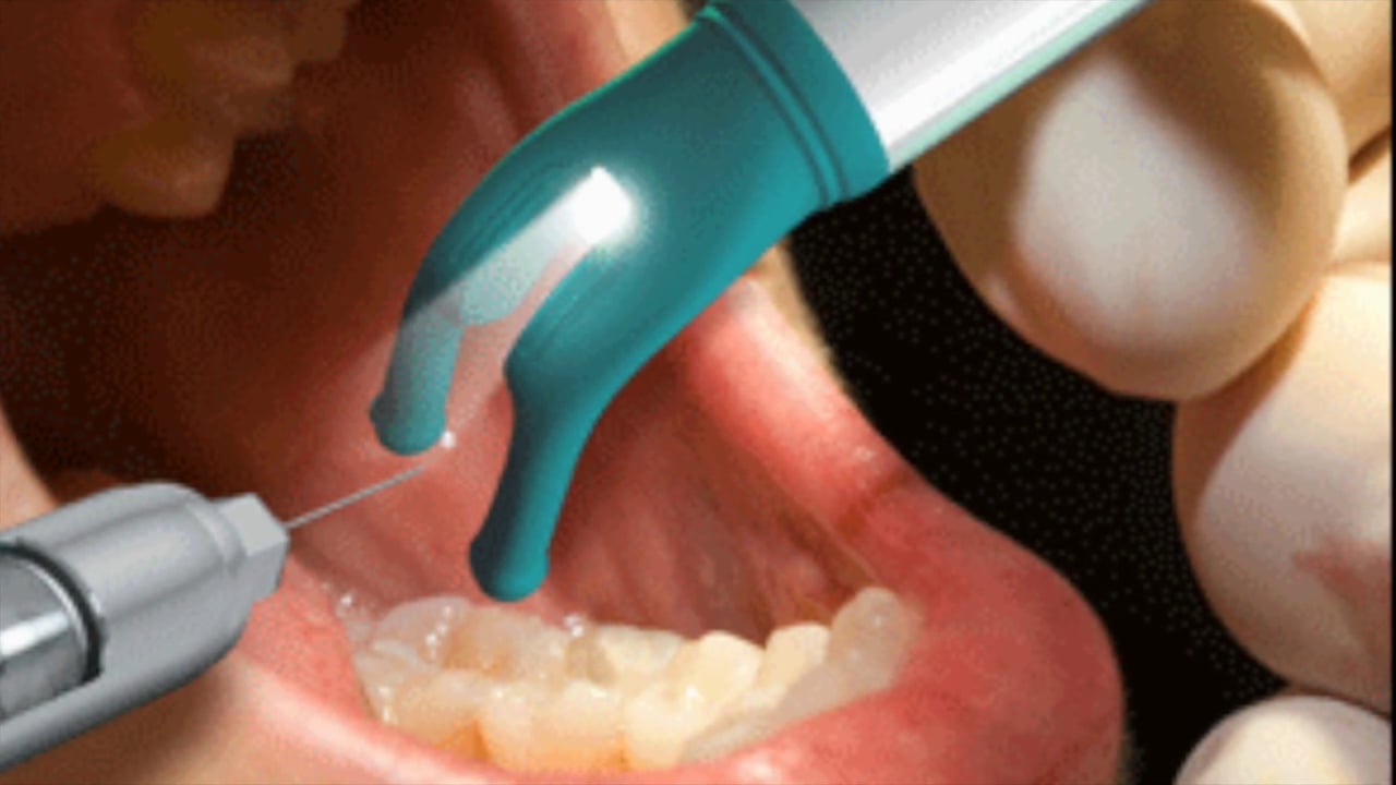 Some dental clinics in Costa Rica are using Dental Vibe to give painless injections.