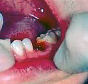 In Costa Rica, when you get a dental implant, it is normal for oozing of blood for about 24hrs.
