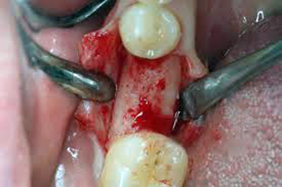 In Costa Rica, when you get a dental implant, the gum is cut and the bone is exposed.