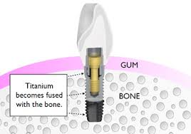 There are many different types of dental implants used in Costa Rica