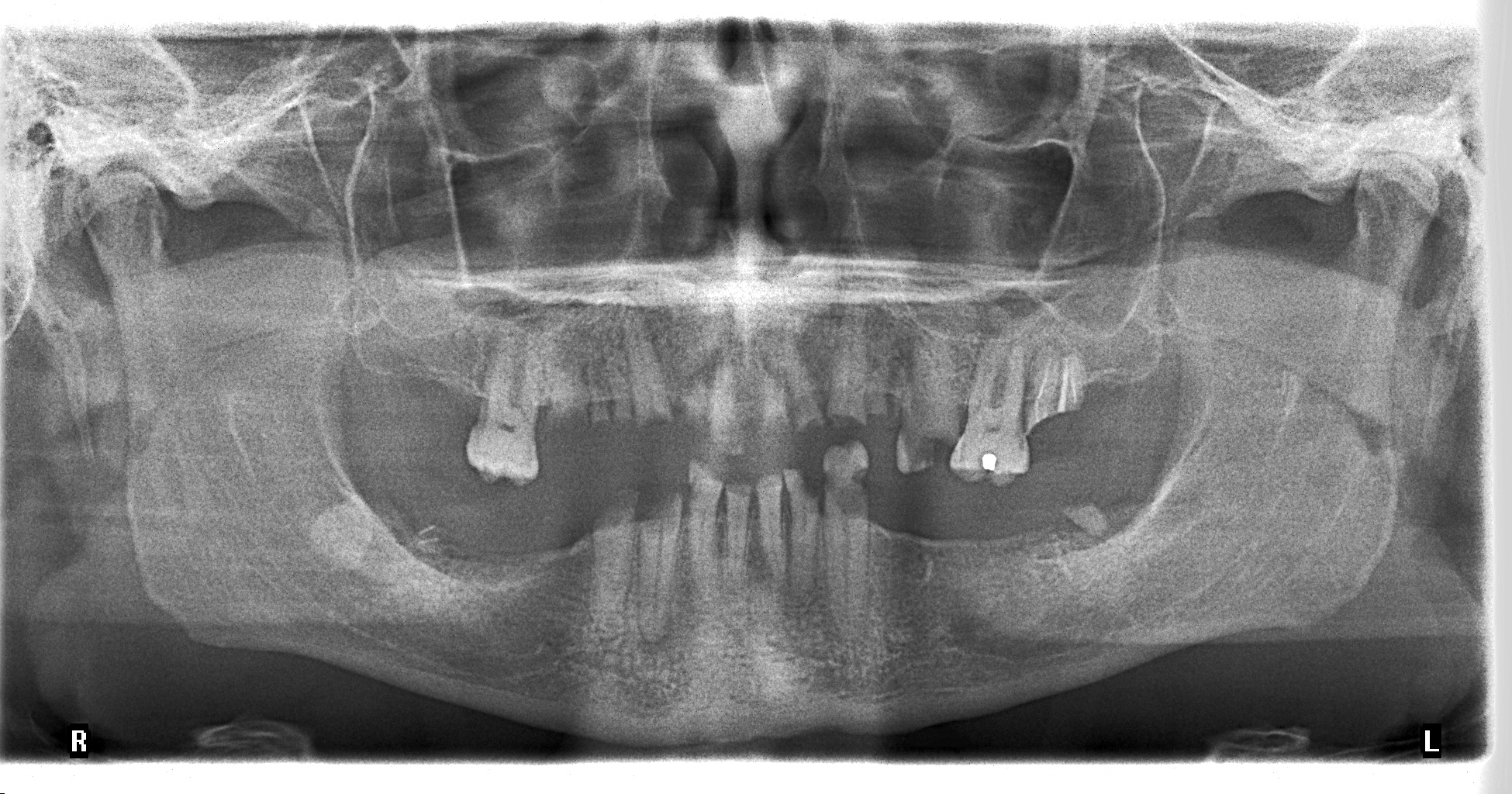 Getting dental implants in Costa Rica? You need a digital Panoramic X-ray.