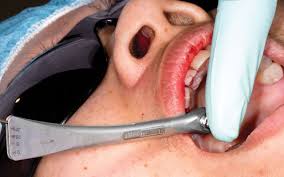 Dental implant being torque tested in Costa Rica