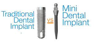 A mini dental implant is a lot smaller than a tradtional dental implant