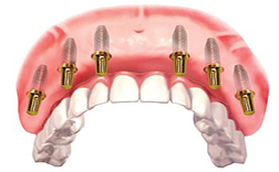 All on 6 Costa Rica Dental Implants Save A Lot All on 6 Costa Rica Dental Implants Save A Lot
