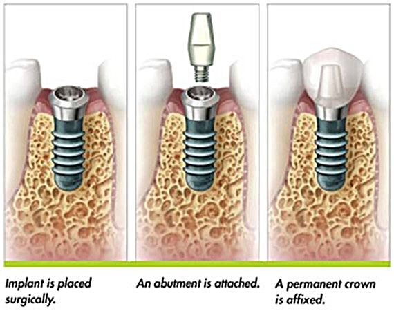 Dental implants in Costa Rica are 61% less than dental implants in the US.