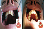 Costa Rican Dental - Implants for A Lot Less.