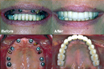 Costa Rican Dental - 1 Stage Dental Implants for A Lot Less.