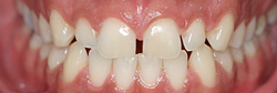 Exceptional porcelain veneers and pure Emax porcelain crowns at a substantial discount.