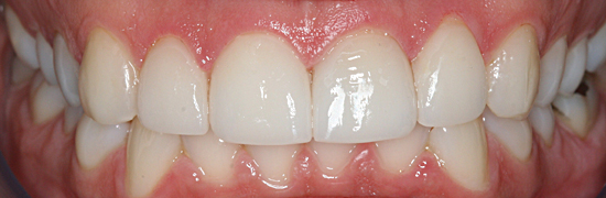 World Class Porcelain Veneers at Substantial Discount