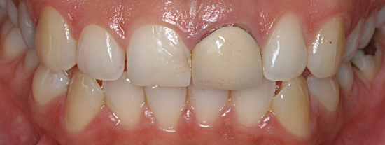 World Class Porcelain Veneers at Substantial Discount